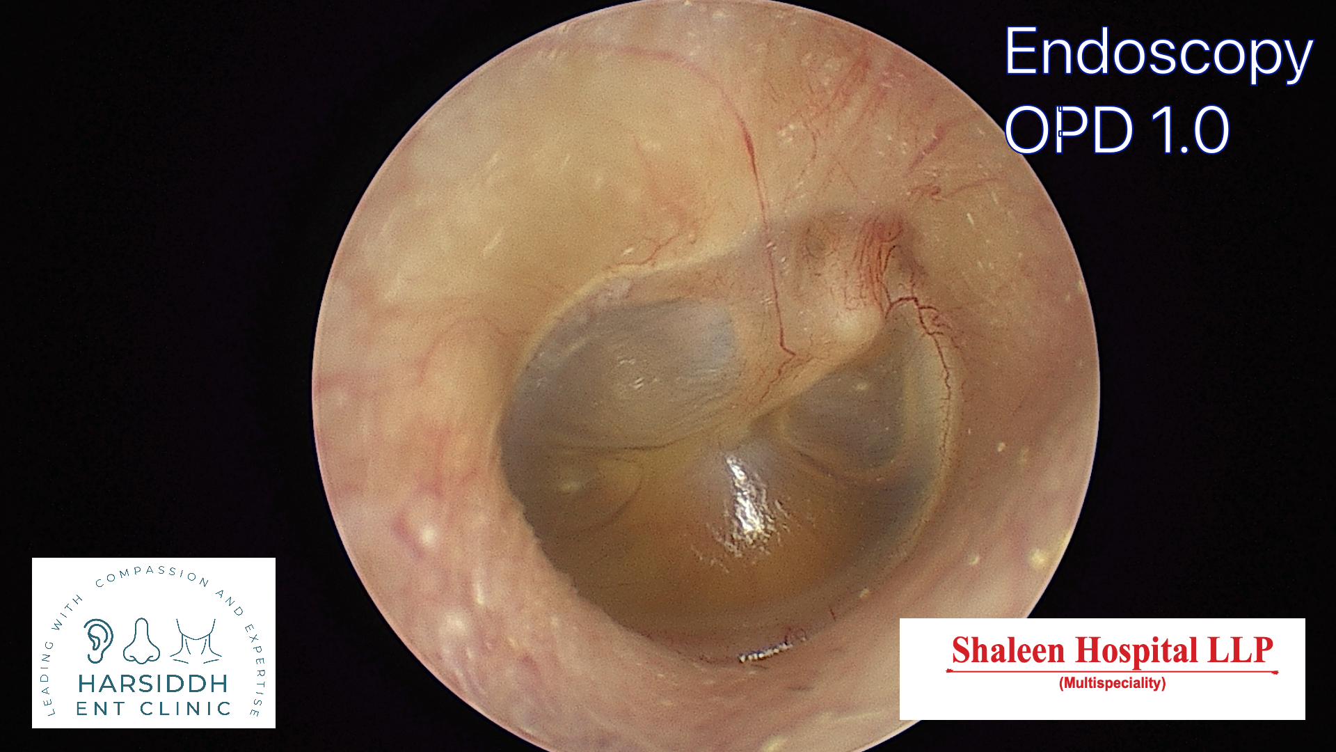 Recognizing Early Signs of Hearing Loss and Treatment Options