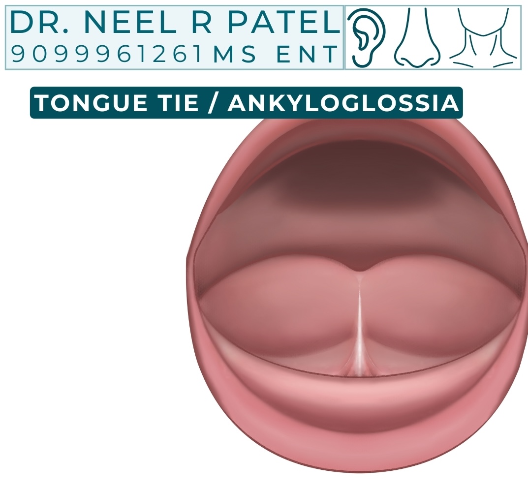 Tongue Tie (Ankyloglossia) and Its Treatment: A Comprehensive Guide for Parents and Adults
