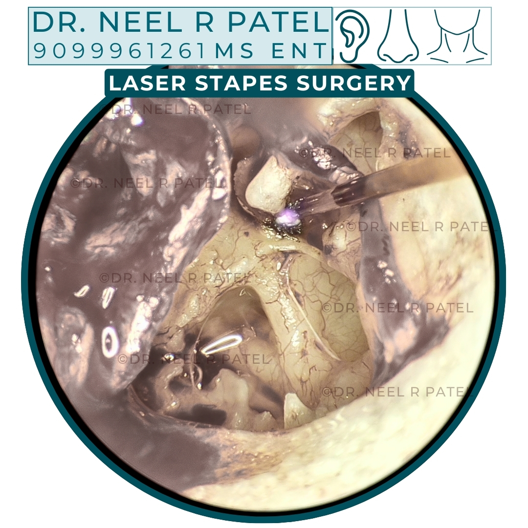 Restoring Hearing with Precision: Understanding Otosclerosis and Advanced Laser Stapes Surgery