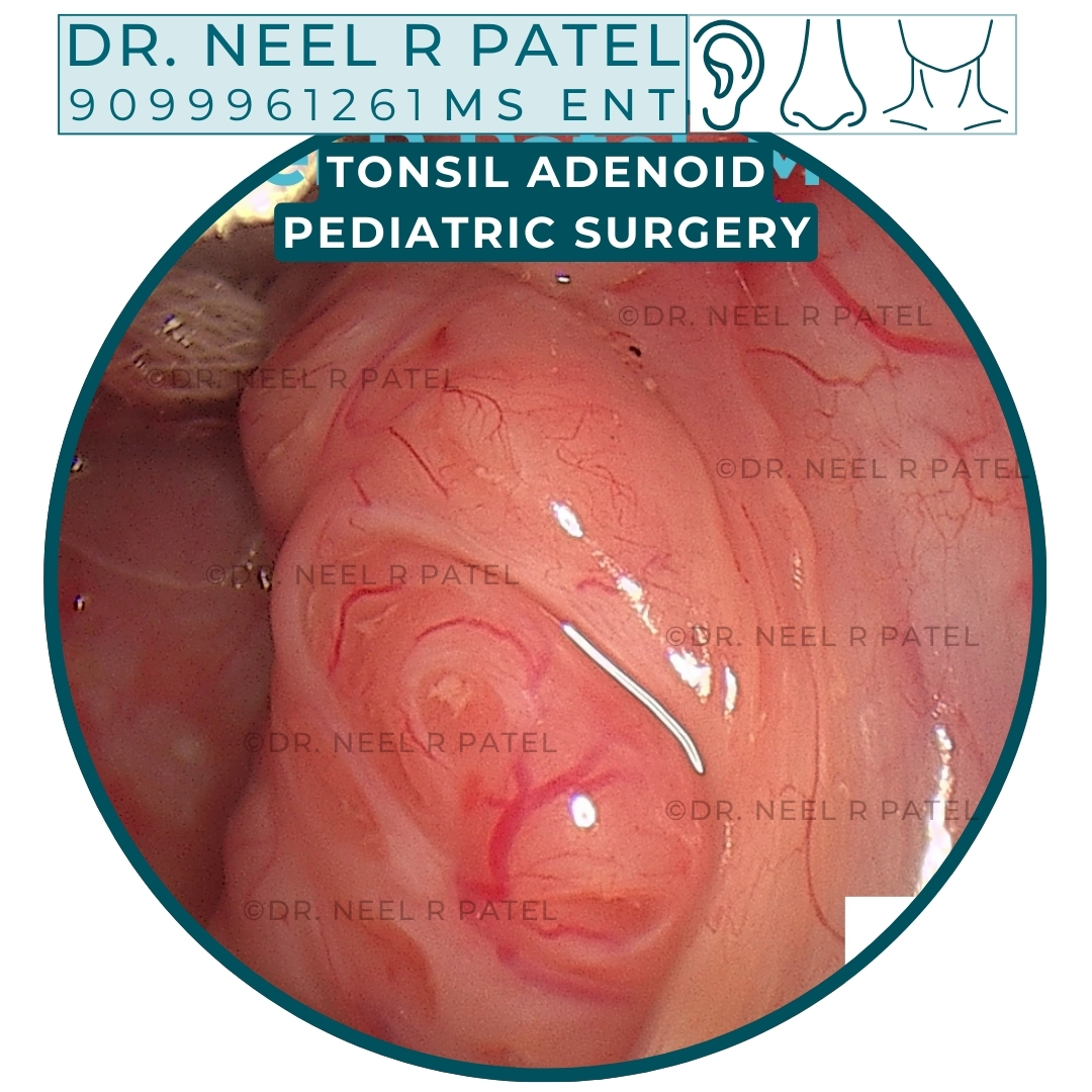 Is Your Child’s Mouth Breathing and Snoring Causing Recurrent Ear Infections? The Adenoid-Ear Connection Explained